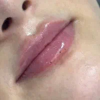 تخفیف تزریق فیلر لب