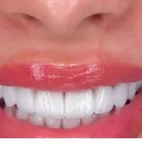 کامپوزیت دندان عصبکشی روکش متخصص دندانپزشک تهرانسر