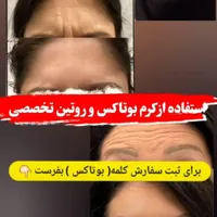 درمان چین و چروک|خدمات آرایشگری و زیبایی|جوادآباد, |دیوار