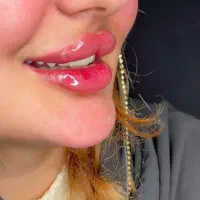 ژل لب و فیلر بوتاکس آنزیم فول فیس گونه چانه مزو