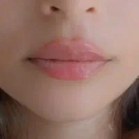ژل لب،بوتاکس،جوانساز،فیلر و کات گونه