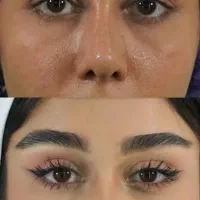 مرکز بلفاروپلاستی لیزری دیجیتالی مشهد/شقیقه/غبغب