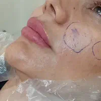 تزریق ژل وبوتاکس
