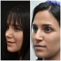 تخفیف ۵۰ درصدی عمل بینی