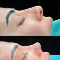 بینی لیپو ابدو جراحی زنان با ( چک صیادی )