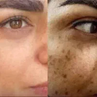 با لک های مقاوم صورتت برای همیشه خداحافظی کن