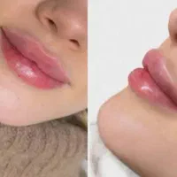 زیبایی تزریق ژل بوتاکس چربی جراحی لابیاپلاستی