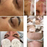 تخفیف ویژه پاکسازی صورت
