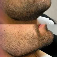 تخفیف ژل،بوتاکس، مزو توسط پزشک زیبایی