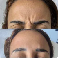 بوتاکس صورت و زیربغل و میگرن