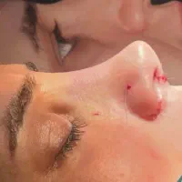 اف ویژه جراحی بینی در بیمارستان فقط ۳۹