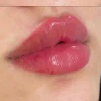 ژل وبوتاکس