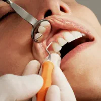 خدمات حرفه ای دندان پزشکی،عصب کشی دندان های جلویی