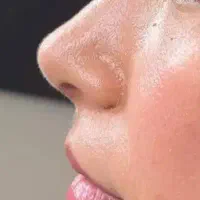 لیپو ابدو مامو پلاستی و پروتز و رینوپلاستی