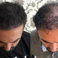 پک کامل تقویت ریشه مو  مناسب موهای ضعیف و شکننده