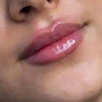 جشنواره عیدانه تزریق ژل و بوتاکس و لاغری در کلینیک