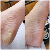 پدیکور کفسابی پا کاملا تخصصی ،تخفیف باورنکردی 349