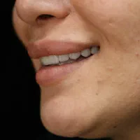 ایمپلنت اقساطی عصبکشی روکش لمینت دندانپزشکی قسطی