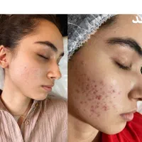 فشیال پاکسازی لیزر پوست جوانساز