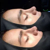 عمل جراحی بینی فقط ۴۵ میلیون تومان