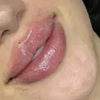 ژل و فیلر