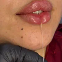 تزریق فیلر و بوتاکس به صورت قسطی توسط پزشک