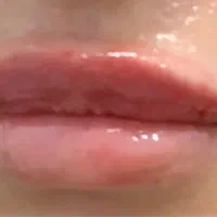 ژل و بوتاکس و مزوتراپی ها توسط پزشک