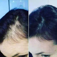 دیگه نگران ریزش مو نباشید