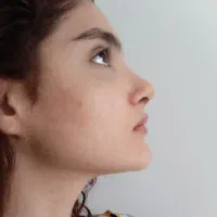 حرفه ای ترین روش عمل بینی در تهران