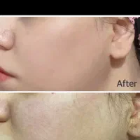 پوست کره ای ومزو نیدلینگ باکوکتل های تخصصی