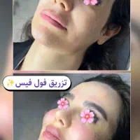 آف ویژه آموزش ژل و بوتاکس به همراه آموزش مجازی