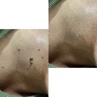 رفع انواع خال وزگیل،شقاق وزائد مقعد