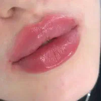 خدمات ژل و بوتاکس و مزو