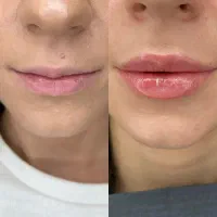ژل بوتاکس فیلر زیبایی درمانی توسط پزشک