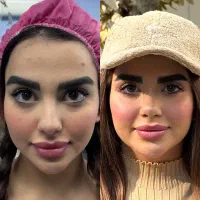 بینی رویایی تو با عمل بینی