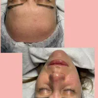 فیشال پاکسازی درمان لک جوش و اسکاراکنه