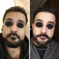 رویش ریشات حتمیه