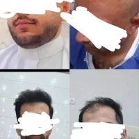 کاشت مو و ابرو طبیعی و تخصصی