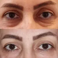 رفع تیرگی و چروک دور چشم