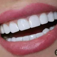 جشنواره کامپوزیت دندان فقط 799ت