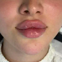 ژل لب ۸۰۰بوتاکس۷۰۰