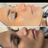 جوانسازی با دستگاه فقط۶۰۰