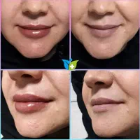 تزریق ژل بوتاکس جوانسازی پی آر پی کربوکسی و لاغری