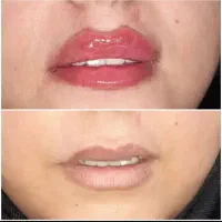 بوتاکس لیزر ژل چربی لابیاپلاستی مطب