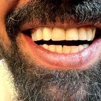 دندان ثابت. روش دندانسازی متحرک  ثابت  جدید