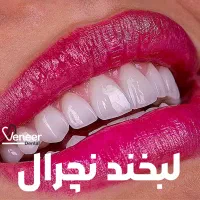 دندانپزشکی  کامپوزیت  لمینت ( تکنیک لیرینگ)