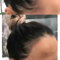 برای پر پشتی موهات اقدام کن نتیجه بگیر