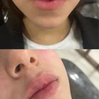 تزریق‌ژل‌وبوتاکس‌در‌کلینیک‌تخصصی‌بامعتبرترین‌برند