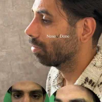 جشنواره جراحی بینی با قیمت ۴۰ میلیون