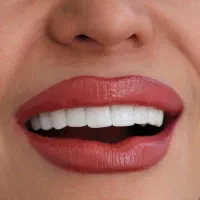 کامپوزیت زیبایی اقساط